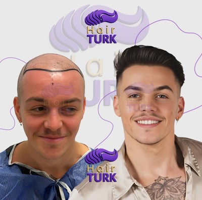 Before & after FUE hair transplant at HairTurk: bald man to full hair, smiling