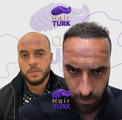 Hair transplant clinic in turkey before after