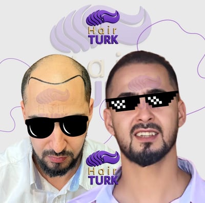 Hair transplant clinic in turkey before after