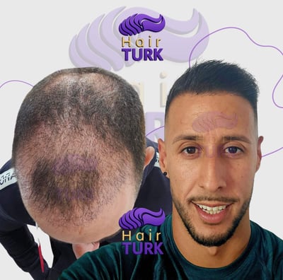 Hair transplant clinic in turkey before after