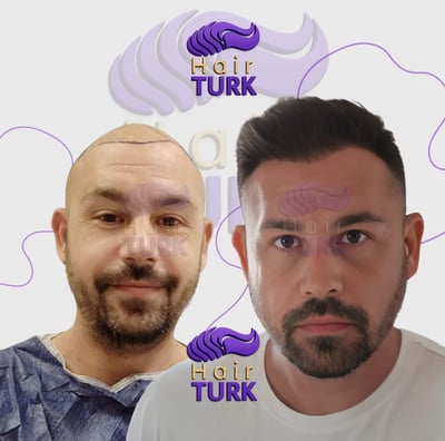 hair transplant clinic in turkey before after