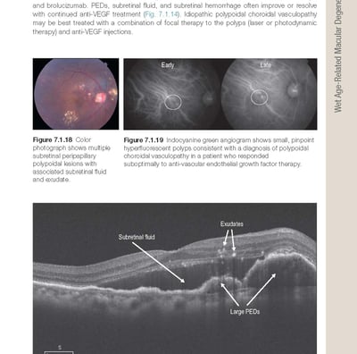 IMAGEM DE UM EXAME DE OCT COM DEGFENERAÇÃO MACULAR RELACIONADO A IDADE