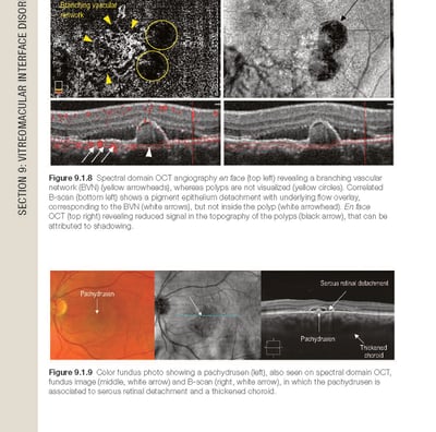 a page of a OCT book with a picture of a OCT edema macular diabético