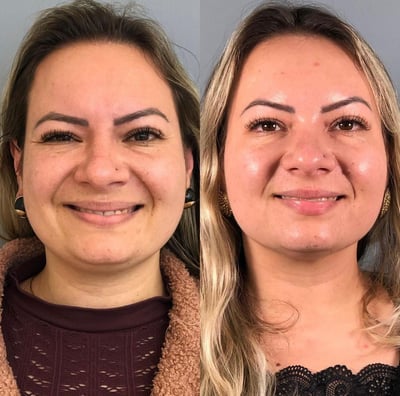 tratamento colageno e biostimulador