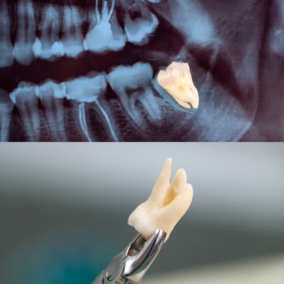 best wisdom tooth extraction | Ekdantam Dental Clinic kopar khairane
