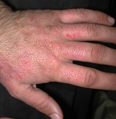 Irritant Contact Dermatitis