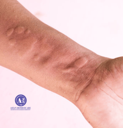 Urticaria Homeopathic treatment