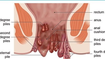 piles-hemorrhoids treatment Unani clinic near Kalaburagi, Karnataka, Dr Hidayath khan