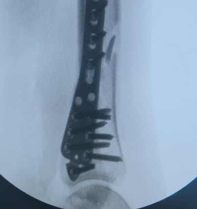 Placa para Tibia Distal