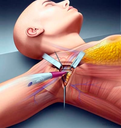 ilustracao medica realista mamoplastia