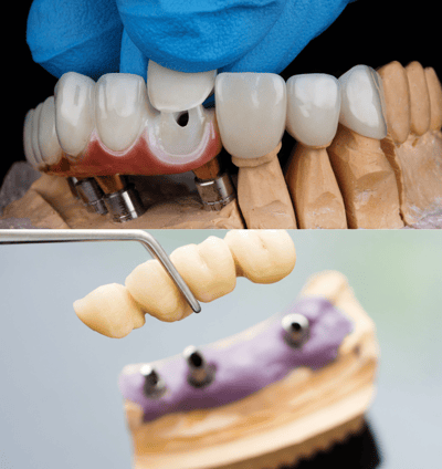 Dental crowns and bridges in navi mumbai | Ekdantam Dental Clinic kopar khairane