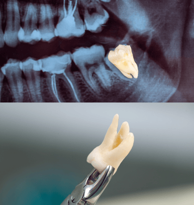 wisdom tooth extraction in Navi Mumbai | Ekdantam Dental Clinic kopar khairane
