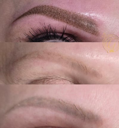 first picture where done elsewhere, second picture we did laser removal, top done by us