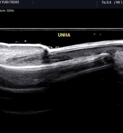 Unha normal com transdutor de alta frequência (22 mhz).