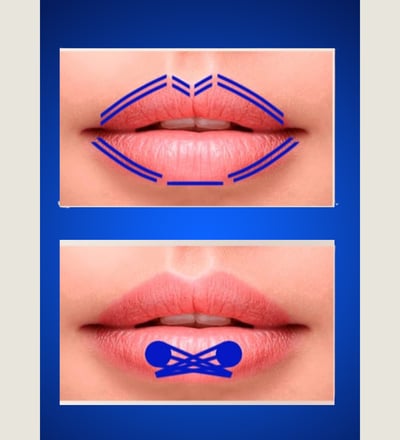 Técnica de preenchimento labial