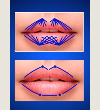 Técnica de preenchimento labial