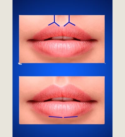 Técnica de preenchimento labial