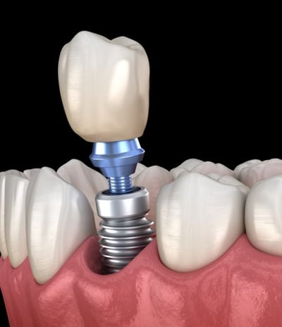 vis de cicatrisation implant dentaire