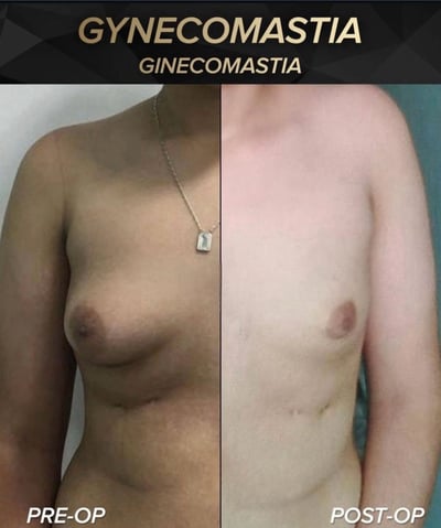 antes e depois ginecomastia 03