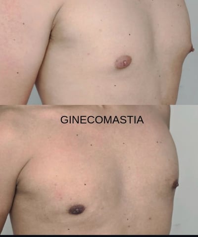 antes e depois ginecomastia 02