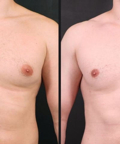 antes e depois ginecomastia 04
