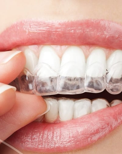 Alineadores invisibles para ortodoncia estética.  Ortodoncia invisible Dra Sors