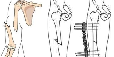 Why do some break when they fall down Without Getting Injured (1)