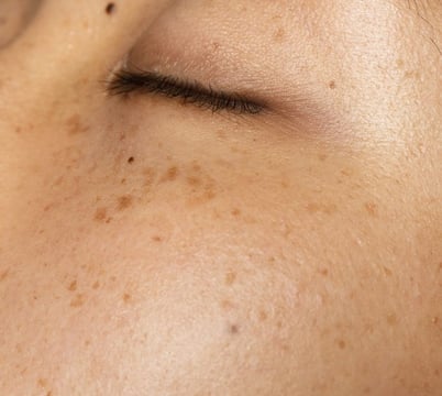 amabelle melasma