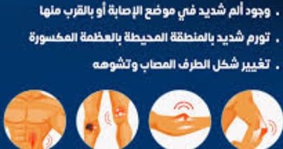 اعراض الكسر