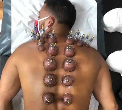 cupping therapy session with patient on supine wearing a mask. 