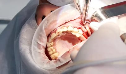 implantes con cirugia oral en sevilla