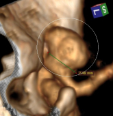 Angiotomografia 3D de mulher de 48 anos. O círculo indica o volumoso aneurisma cerebral.