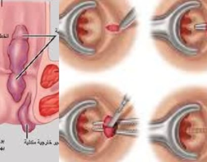 Anal fissures and fistulas: Treatment without surgery