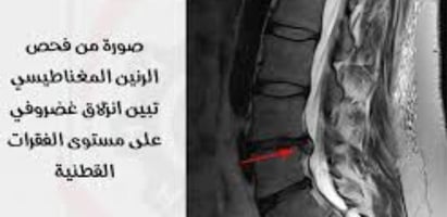 herniated disc,disc herniation,bulging disc,herniated disc surgery