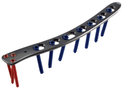 Placa para Húmero Distal Lateral