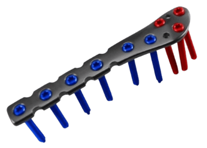 Placa para Peroné Distal Lateral