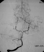 Angiografia vértebro-basilar projeção frontal após a cirurgia no cérebro e remoção da MAV. 
