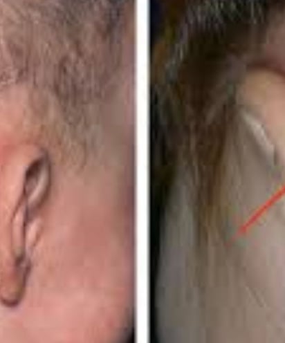 mastoiditis