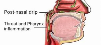 a diagram of the anatomy of the throat of the head and neck oost nasal discharge