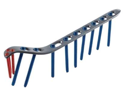 Placa para Húmero Distal Medial