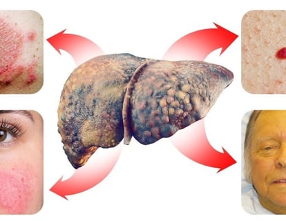 Fatty Liver Disease Can Show Up 