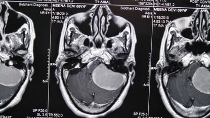 CROWDED SPACE- Cerebello-pontine angle Meningioma