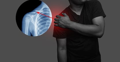 Shoulder Dislocation-  Dr. T. Aravindh MBBS, MS( ORTHO)