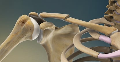 Shoulder Fracture-Dr. T. Aravindh MBBS, MS( ORTHO)
