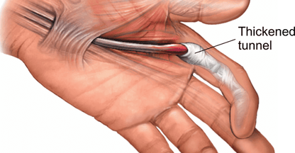 Trigger finger-Dr. T. Aravindh MBBS, MS( ORTHO)