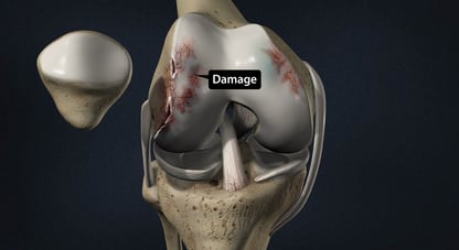 Avasular necrosis Knee- Dr. T. Aravindh MBBS, MS( ORTHO)