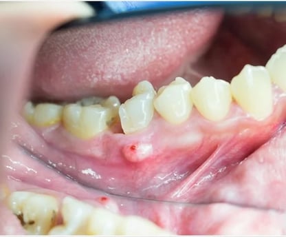 a image showing swelling around one broken molar tooth 