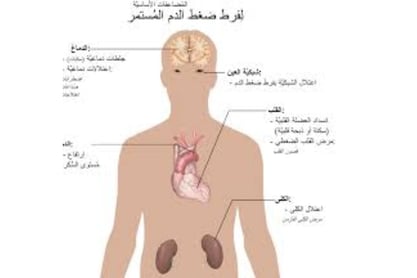اضراره الضغط المستمر
