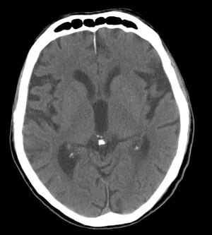 Brain sand or Corpora arenacea. 