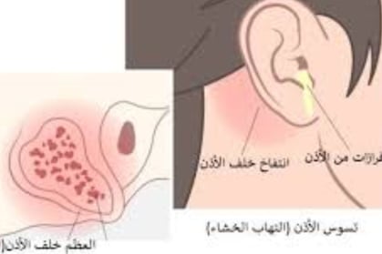 التهاب خلف الاذن افرازات من الاذن